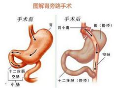 揭秘胃旁路手术 缩胃减肥