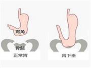 如何防治胃下垂